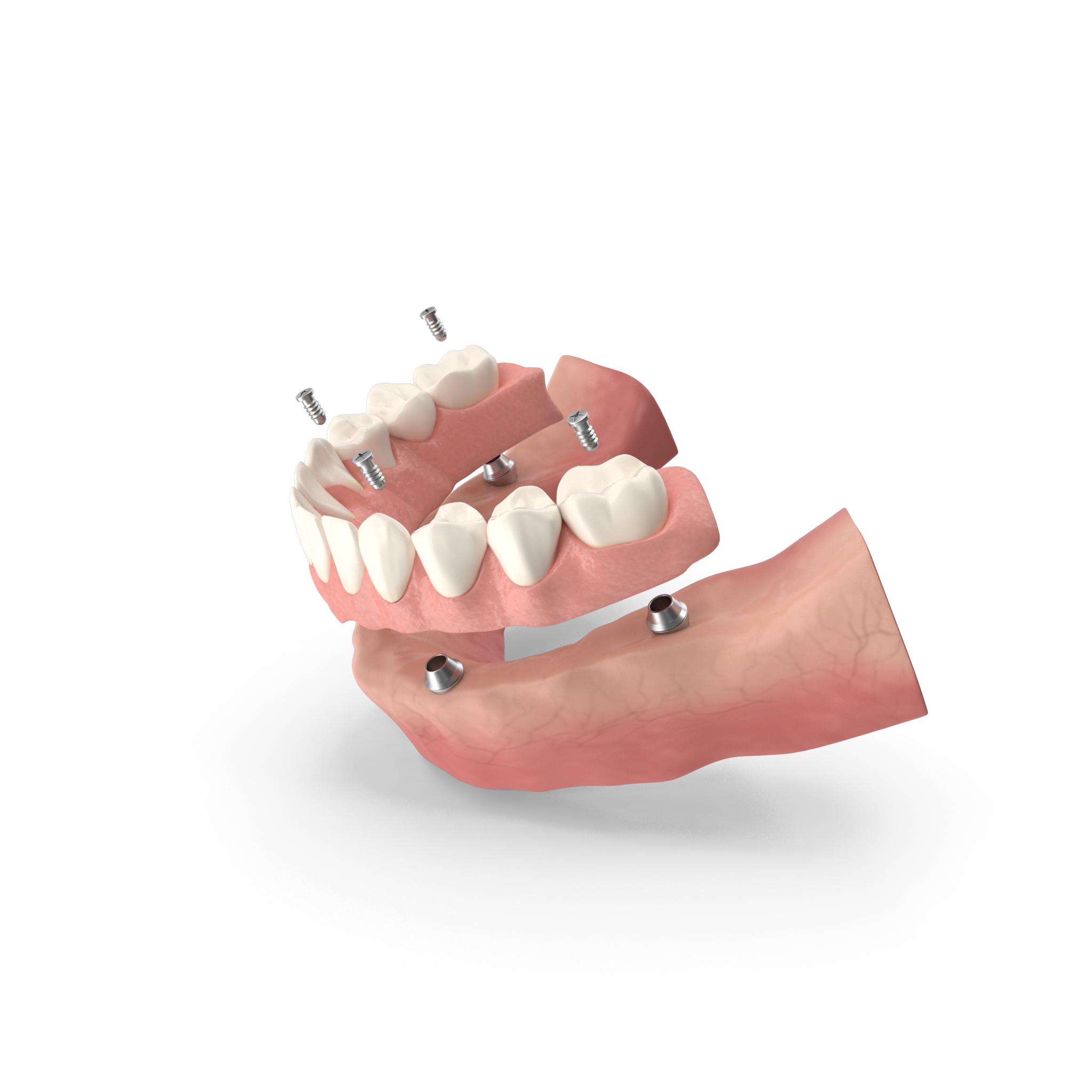 Implant20Supported20Denture.G04.2k