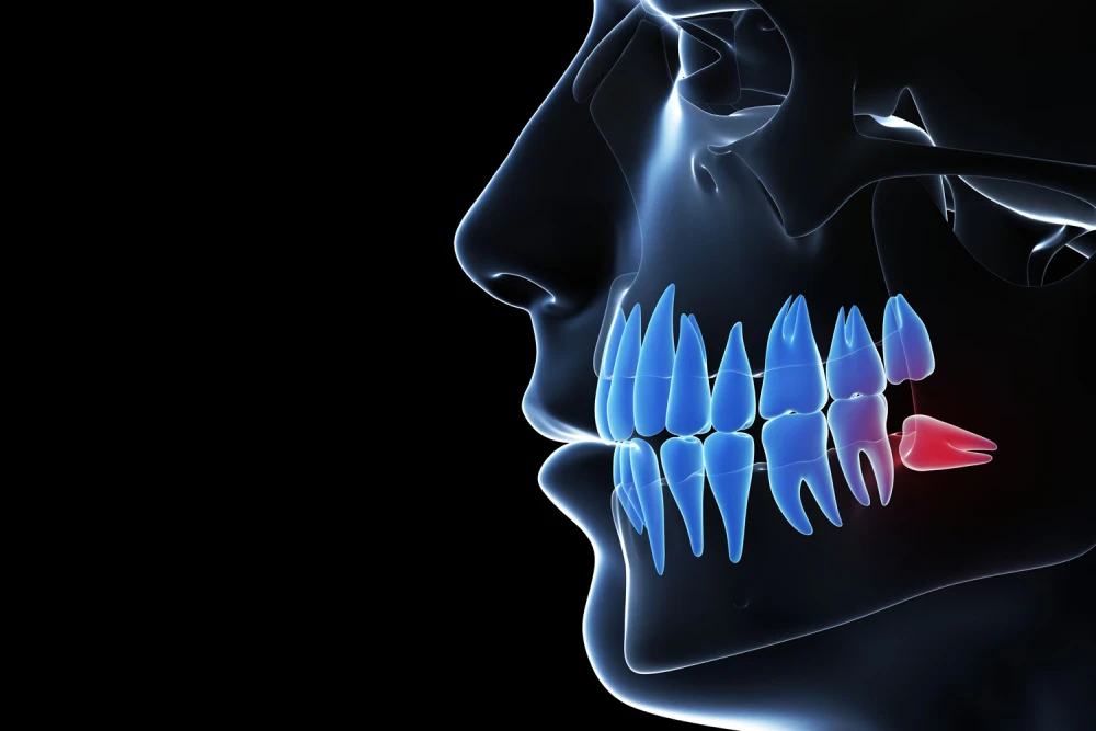 impacted-wisdom-tooth-graphic