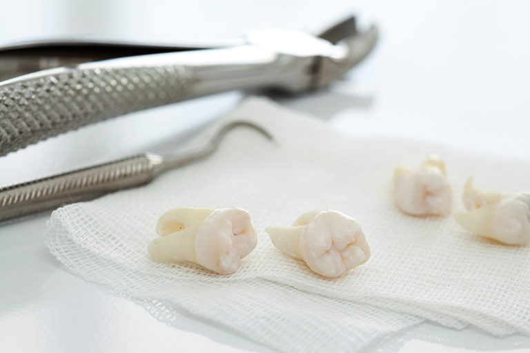 Dental tools and removed teeth