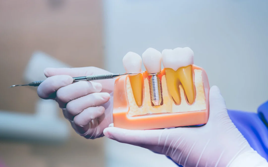 What to Look for When You’re Ready for Dental Implants in Houston?