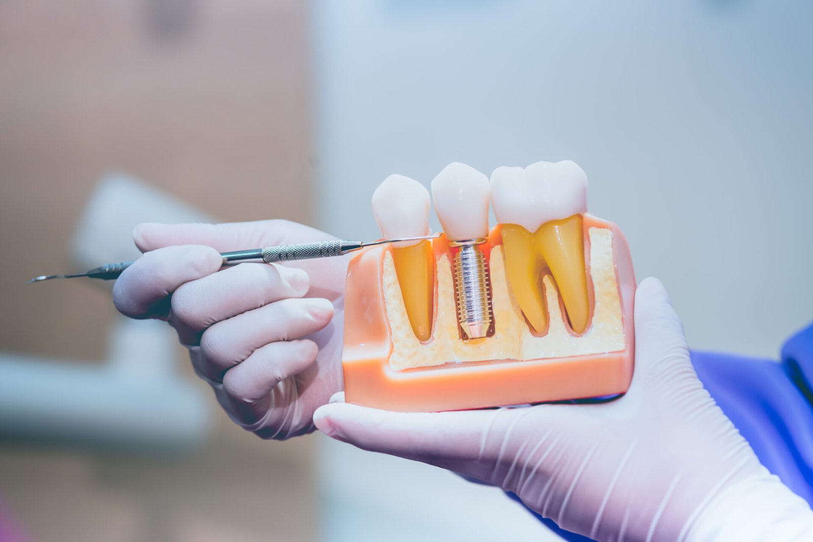 What to Look for When You’re Ready for Dental Implants in Houston?