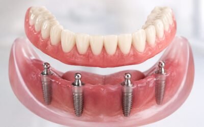 7 Benefits of Choosing All on X Implant Dentures in Houston for Long Term Smile Restoration
