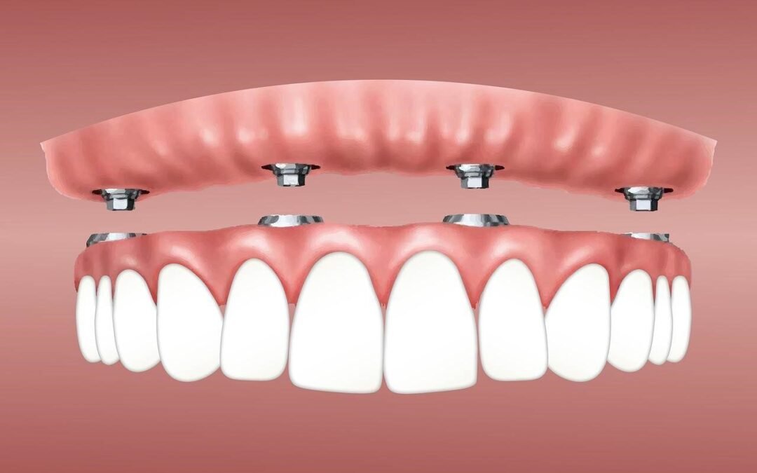 Why Quality Teeth Replacement in Houston Matters for Long-Term Oral Health