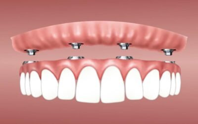 Why Quality Teeth Replacement in Houston Matters for Long-Term Oral Health
