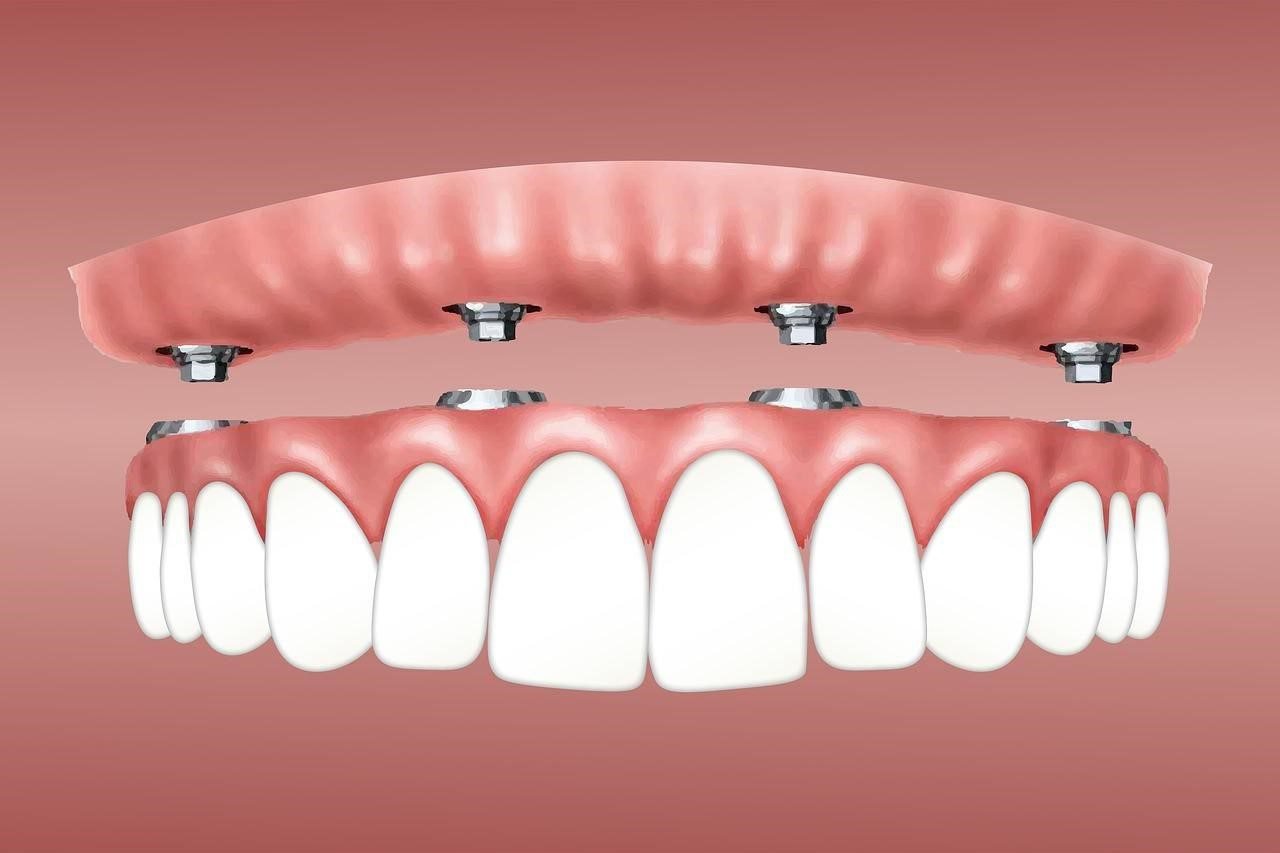 Why Quality Teeth Replacement in Houston Matters for Long-Term Oral Health Why Quality Teeth Replacement in Houston Matters for Long-Term Oral Health
