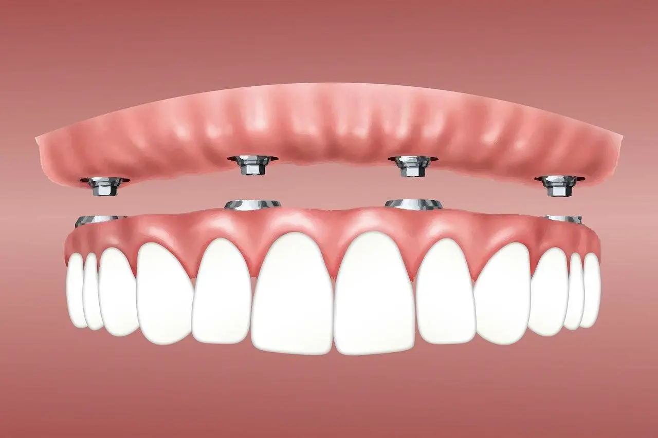 Why Quality Teeth Replacement in Houston Matters for Long-Term Oral Health