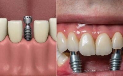 Why Patients Trust Experts for Dental Implant Specialist in Houston Services