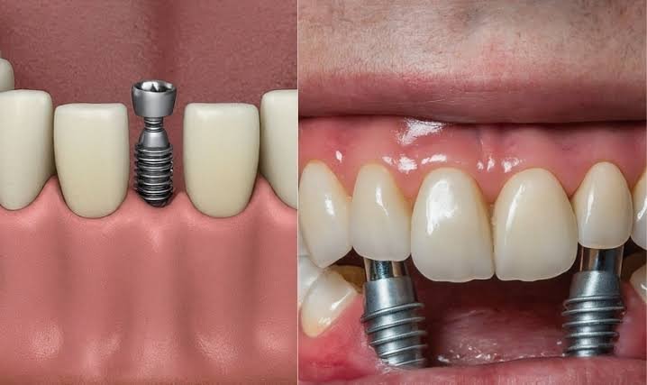 Why Patients Trust Experts for Dental Implant Specialist in Houston Services