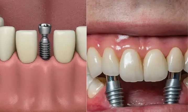 Why Patients Trust Experts for Dental Implant Specialist in Houston Services