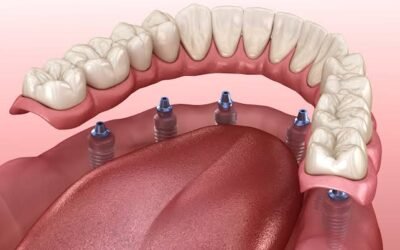 Your Guide to All-on-X Implant Dentures in Houston for Lasting Results