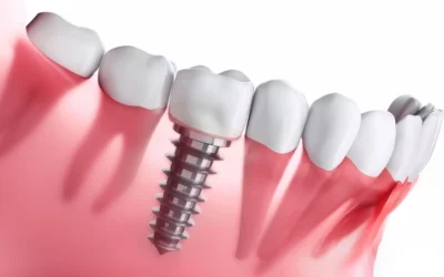 All-on-X vs. Traditional Dentures: Why More Houston Patients Are Choosing Permanent Implants