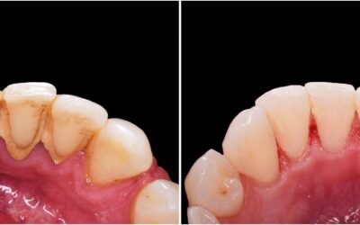 Dental Cleaning vs Deep Cleaning: What’s the Difference?