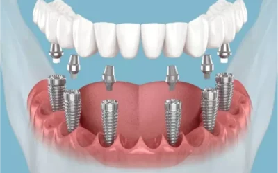 How Long Do Dental Implants Last? Expert Advice
