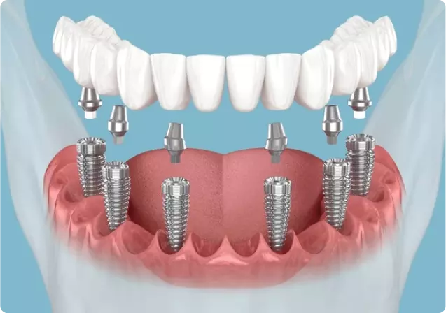 How Long Do Dental Implants Last? Expert Advice