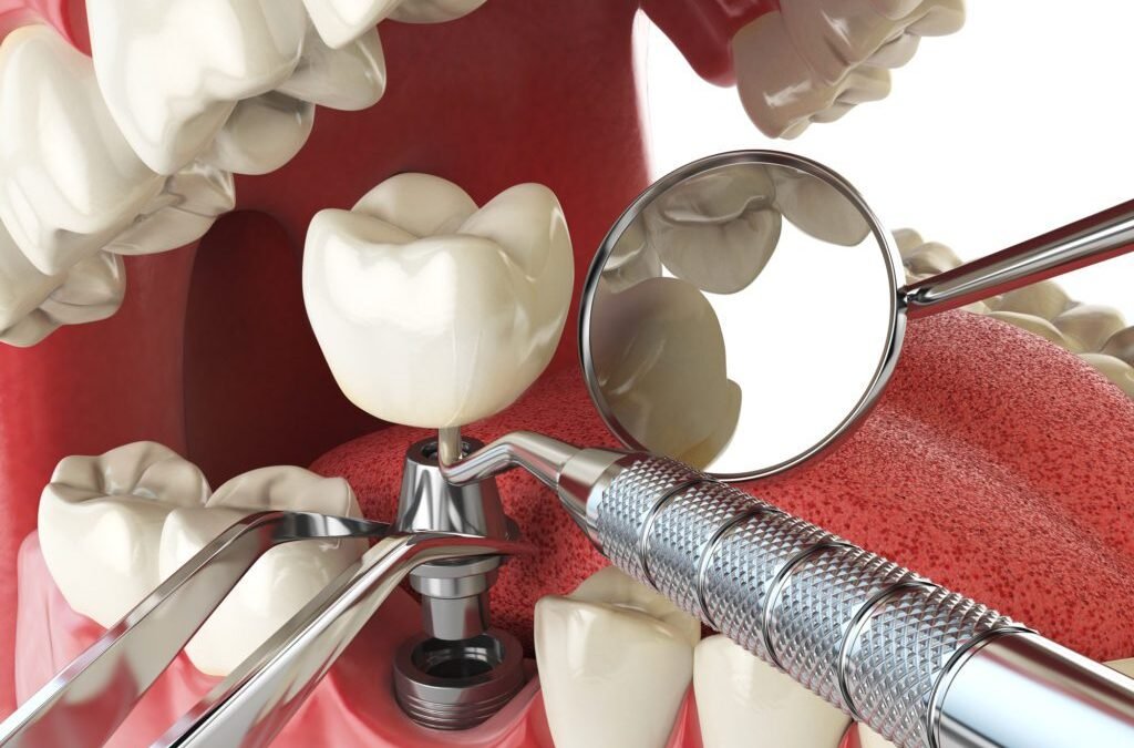 Advanced Dental Implant Treatments in Houston Can Help You Regain Your Smile