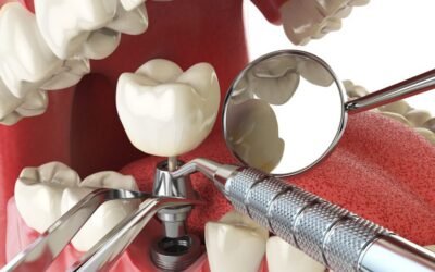 Advanced Dental Implant Treatments in Houston Can Help You Regain Your Smile
