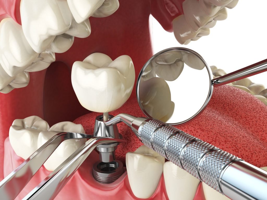 Advanced Dental Implant Treatments in Houston Can Help You Regain Your Smile Advanced Dental Implant Treatments in Houston Can Help You Regain Your Smile