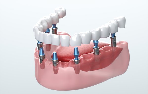 Houston Permanent Teeth Replacement: Choices for a Beautiful Smile